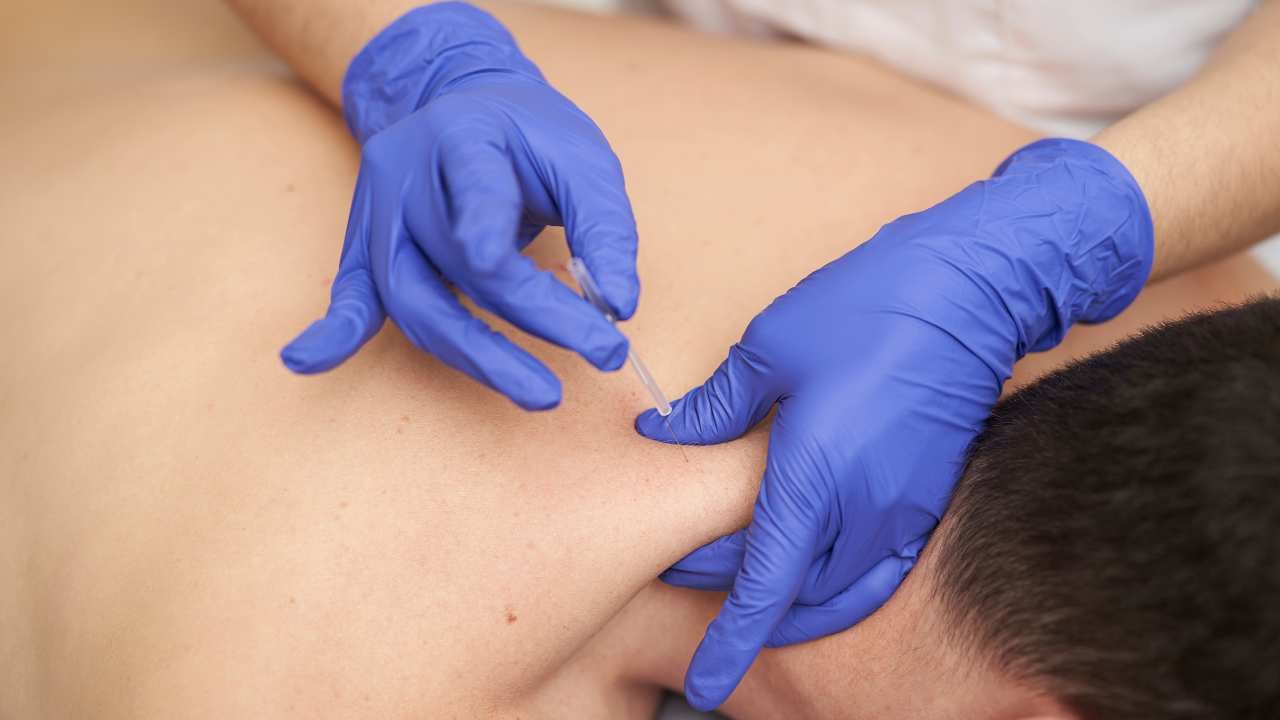 Dry Needling PT